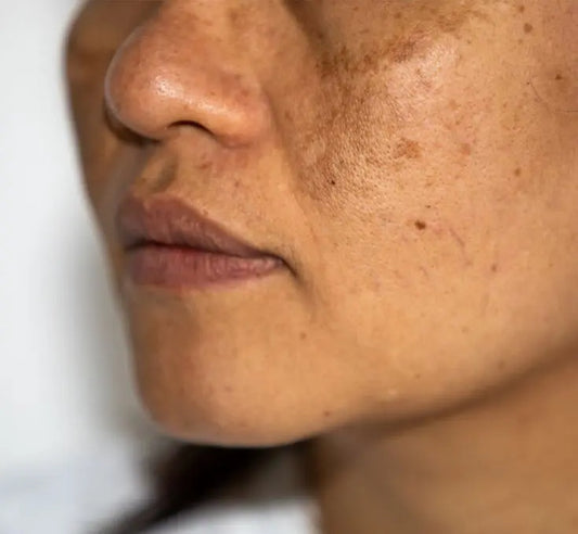 How To Get Rid Of Dark Spots On Face