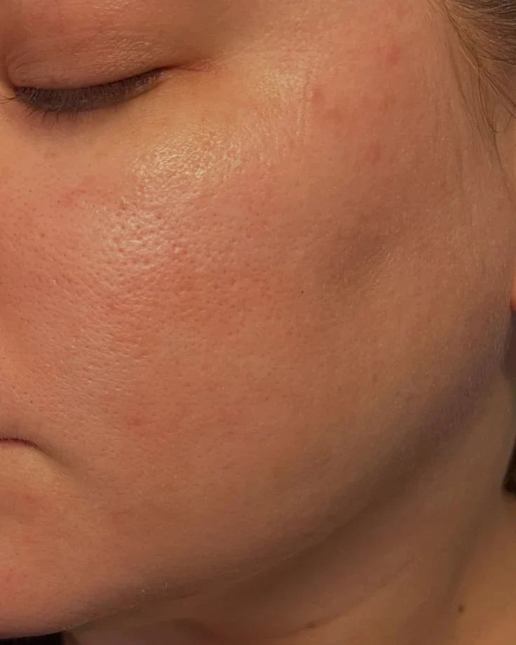 What To Use For Open Pores On Face