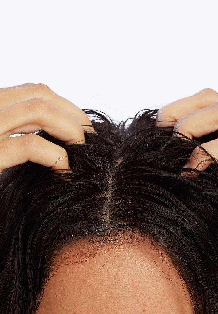 Can Dry Scalp Cause Hair Loss