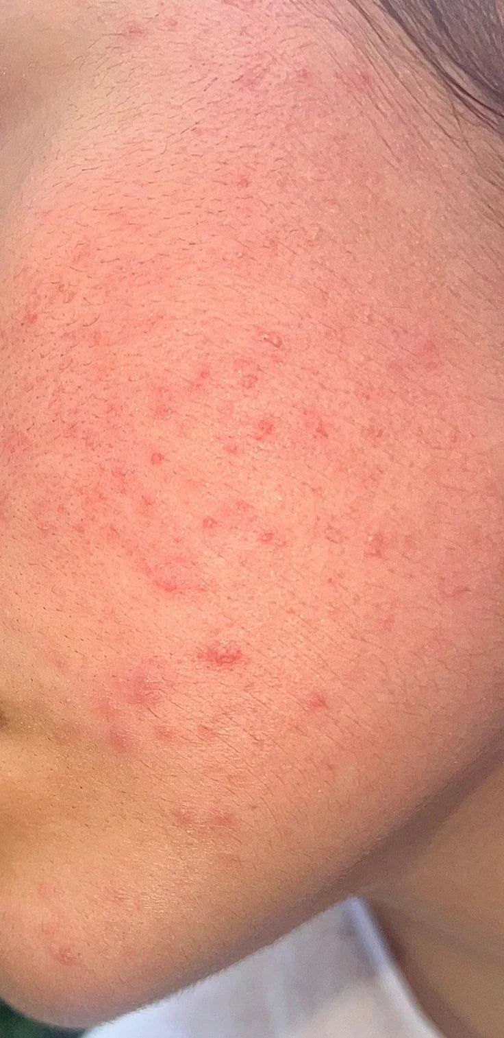 How To Soothe Irritated Skin On Face