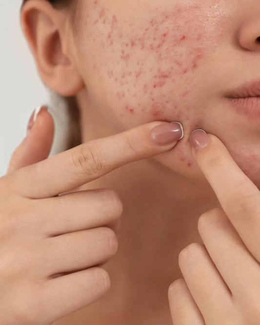 How to Remove Pimple Spots From Face: Safe Routine