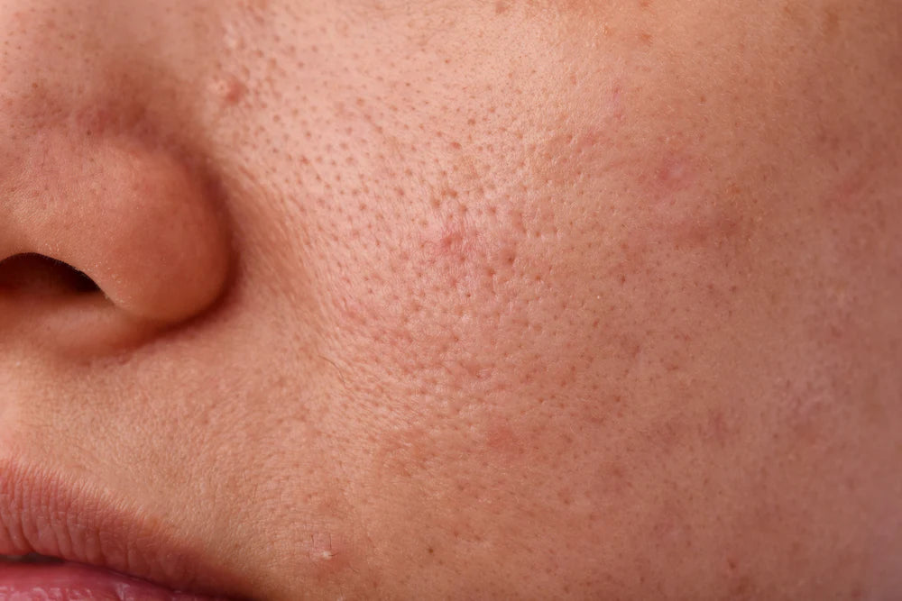 Tackle Clogged Pores By Just Paying Attention To These Small Practices