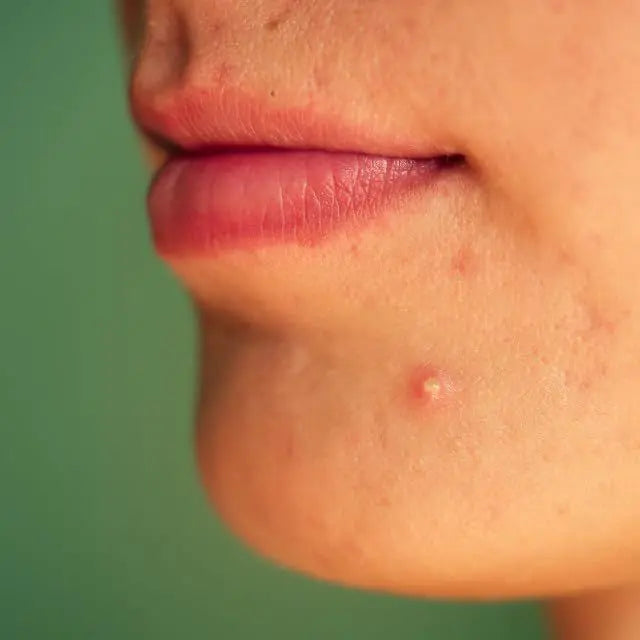How To Remove Dark Spots Caused By Pimples