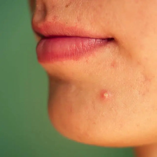 How To Remove Dark Spots Caused By Pimples