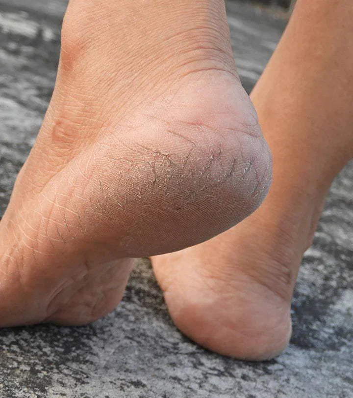 What Causes Cracked Heels