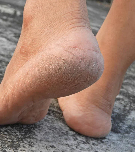 What Causes Cracked Heels