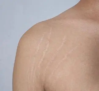 How To Remove Stretch Marks Fast