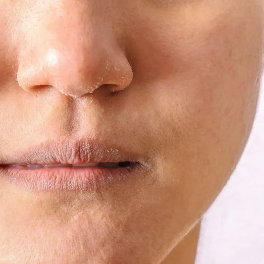 Remedy For Dry Nose In Summer