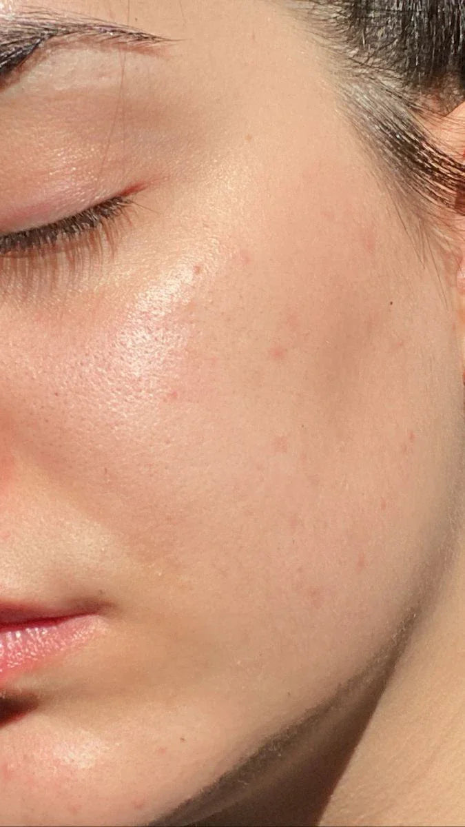 How To Get Rid Of Dull Skin