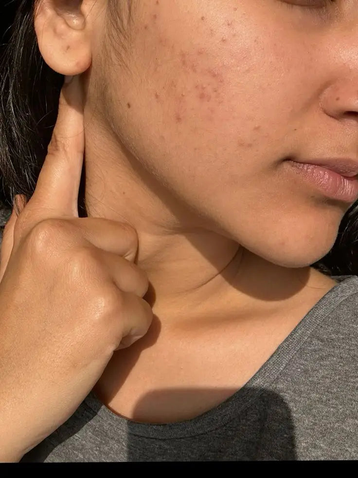 How to Treat Hormonal Acne Naturally at Home