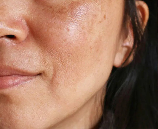 How To Remove Pigmentation From Face Permanently