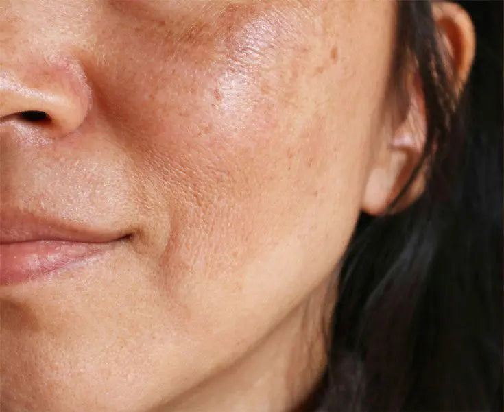 How To Remove Pigmentation From Face Permanently