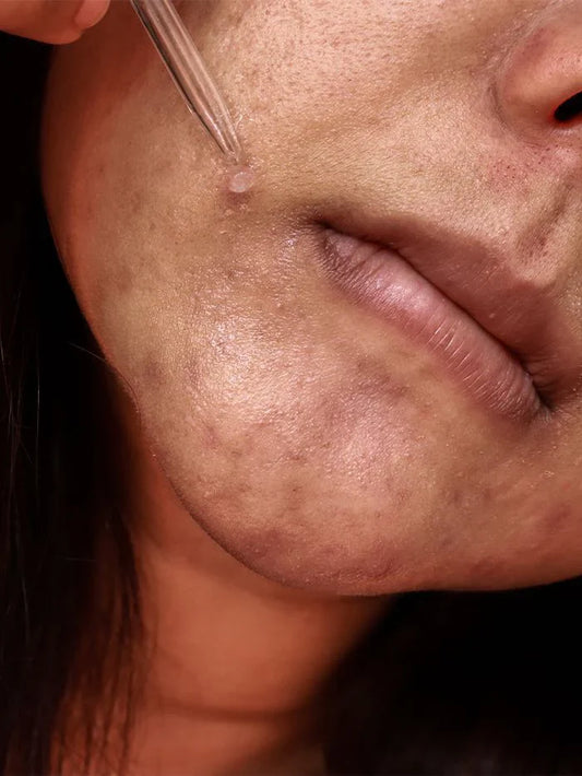 What is Pigmentation on Face