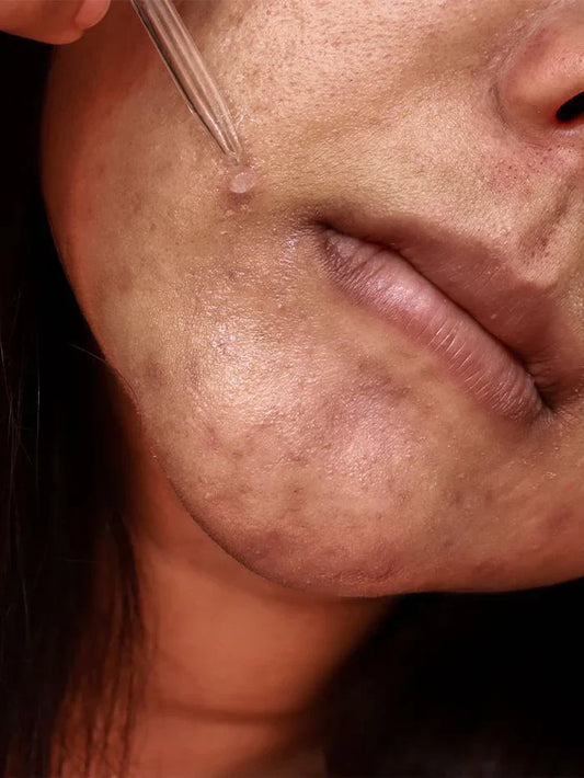What is Pigmentation on Face