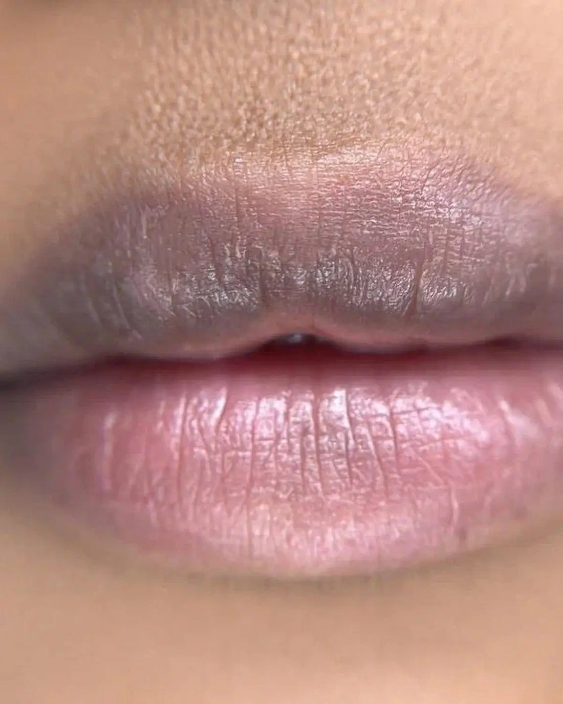 How To Remove Upper Lip Darkness
