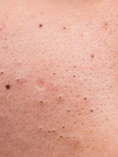 What Are Blackheads