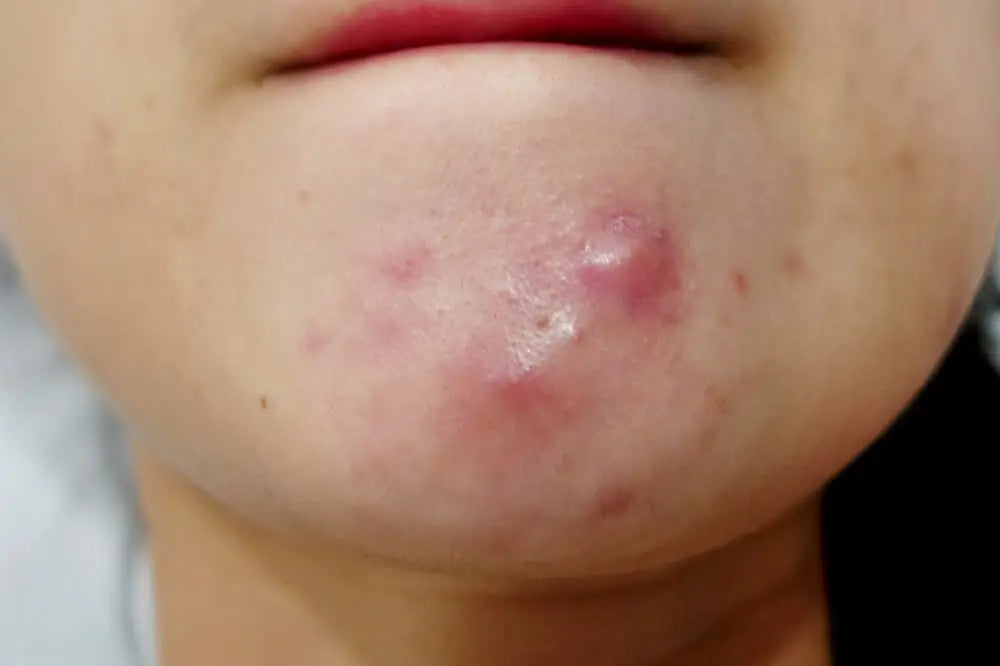 What Causes Pimples On Chin