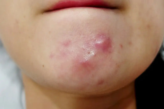What Causes Pimples On Chin