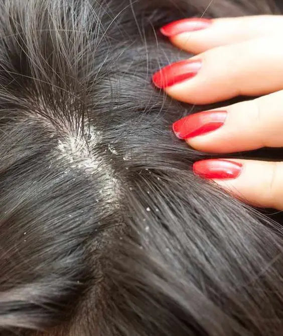 How to Get Rid of Scalp Dandruff