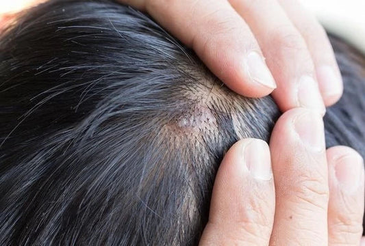 How To Treat Pimples On Scalp