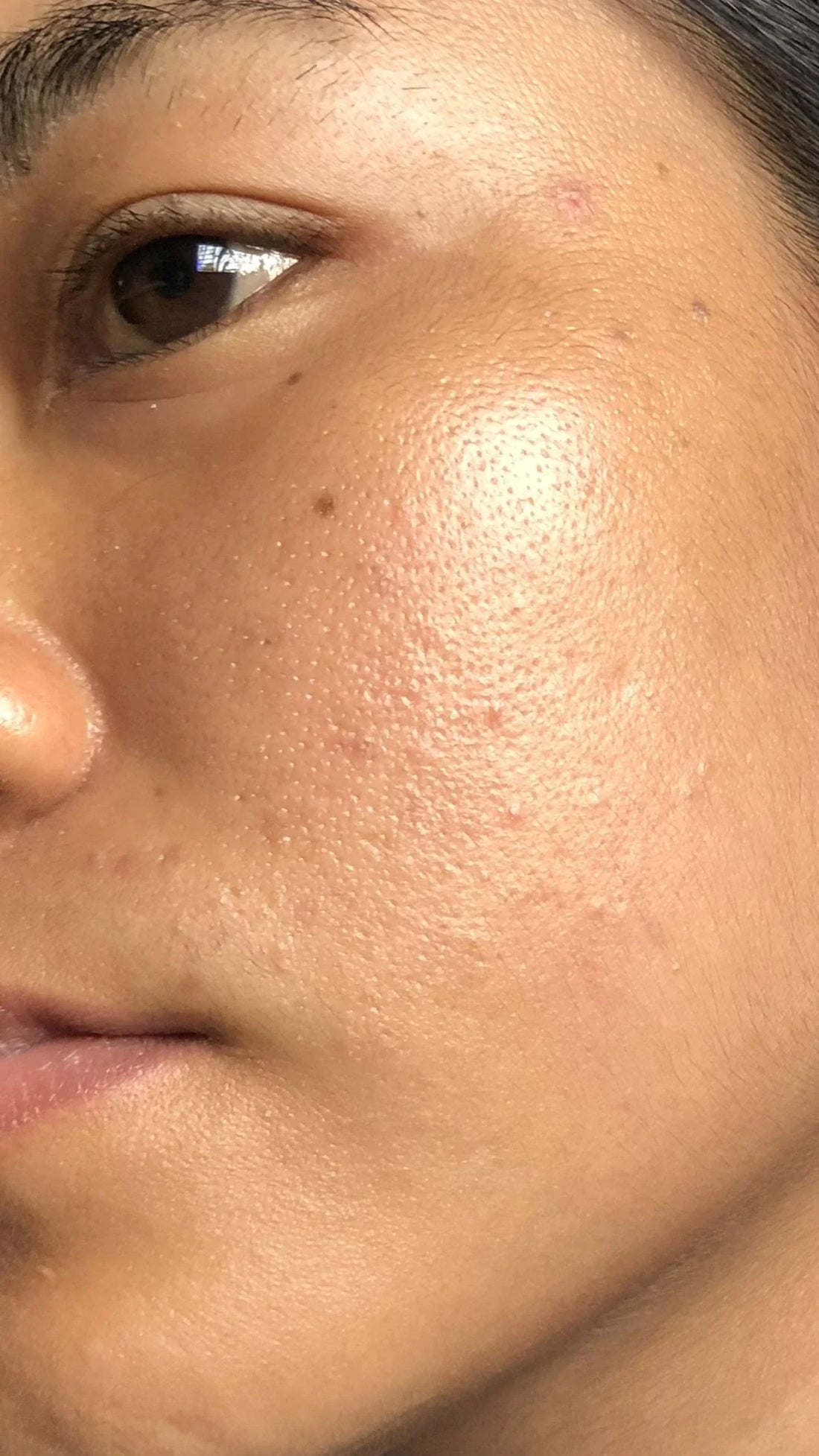 Why Do We Get Open Pores On Face