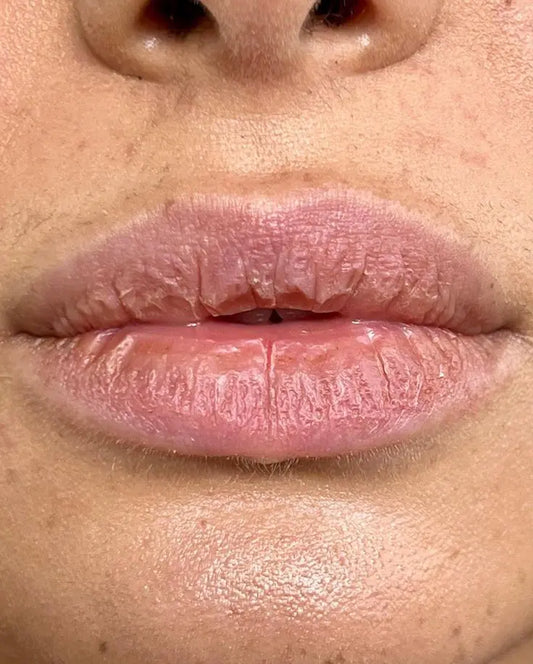 How To Get Rid Of Dry Lips
