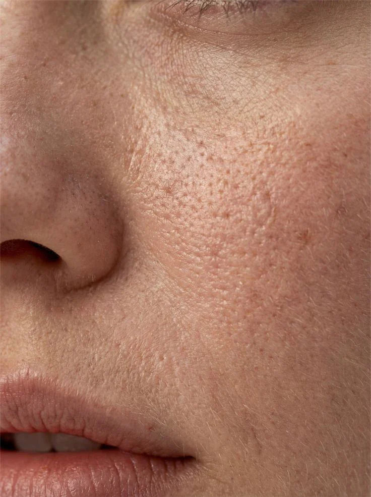 How To Cure Open Pores In Face