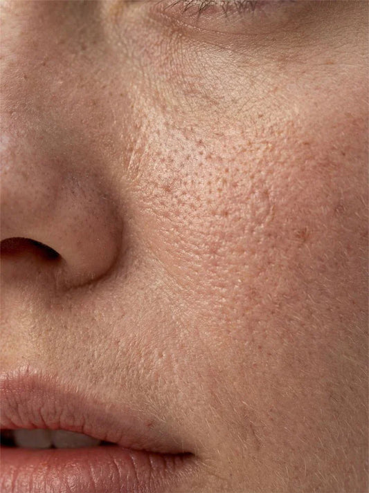 How To Cure Open Pores In Face