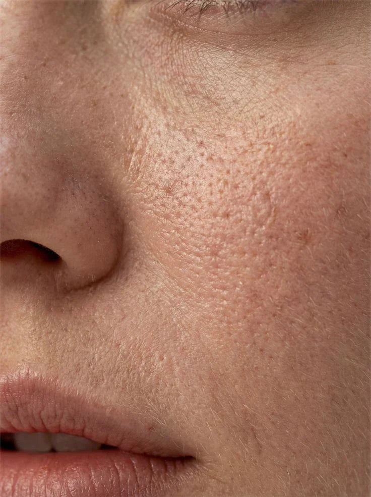 How To Cure Open Pores In Face