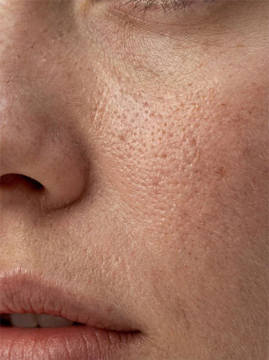 How To Cure Open Pores In Face