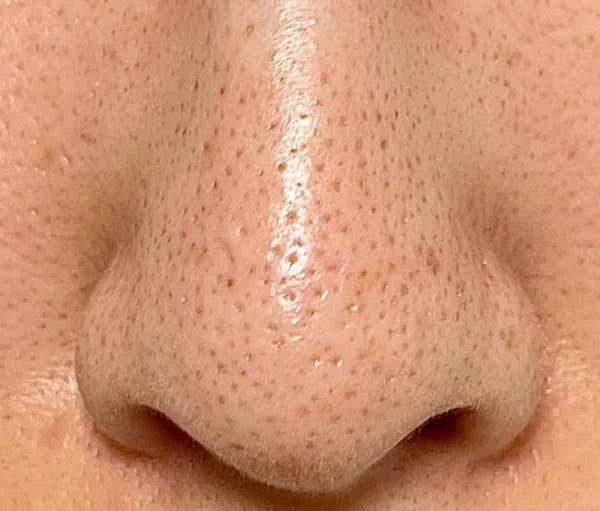 What Causes Blackheads