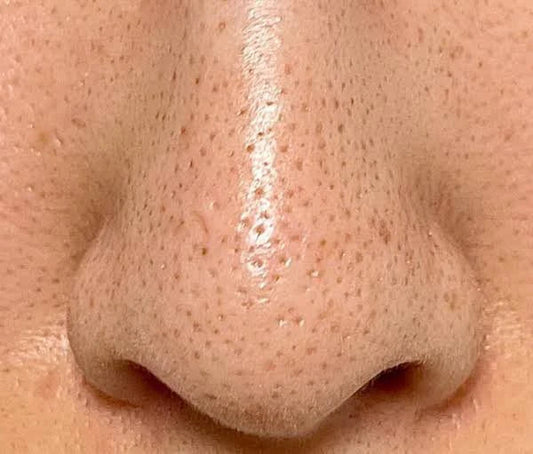 What Causes Blackheads