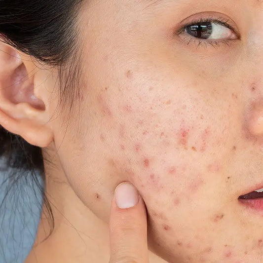 How To Remove Pimples Overnight