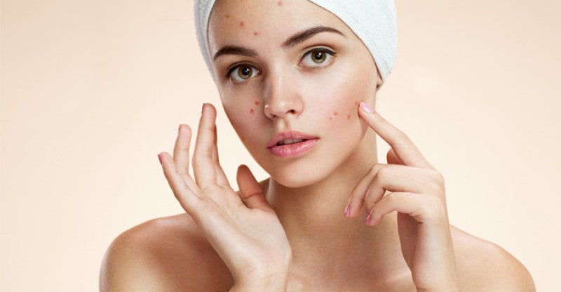 How to get rid of pimples?