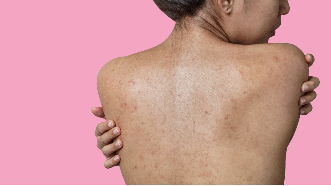 Causes of Bumpy Skin and Body Acne
