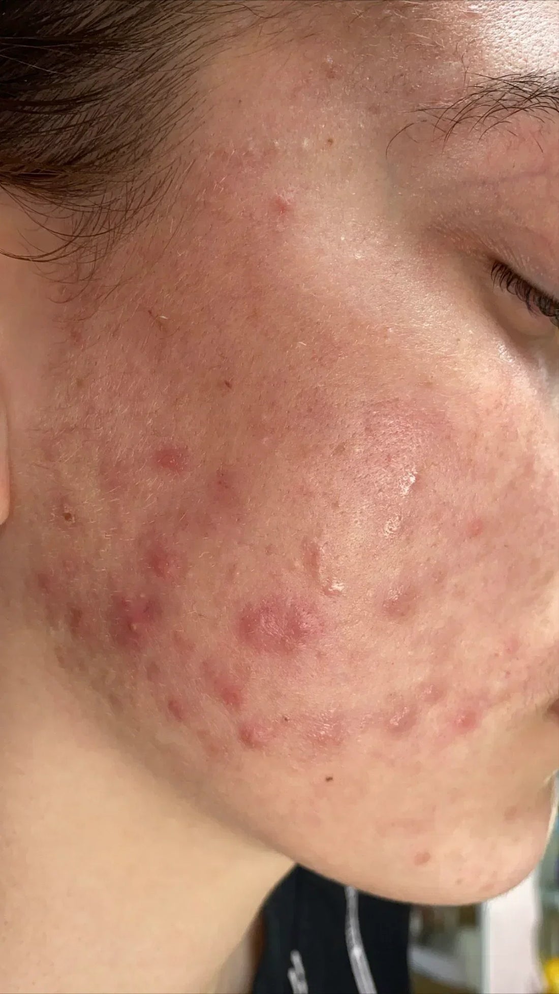 Which Cream Is Best For Pimples And Dark Spots