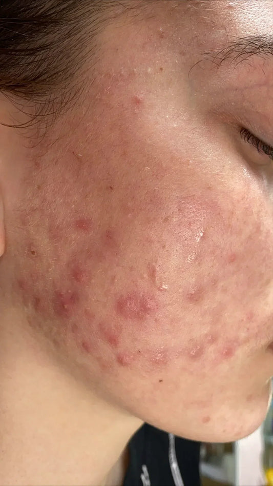 Which Cream Is Best For Pimples And Dark Spots