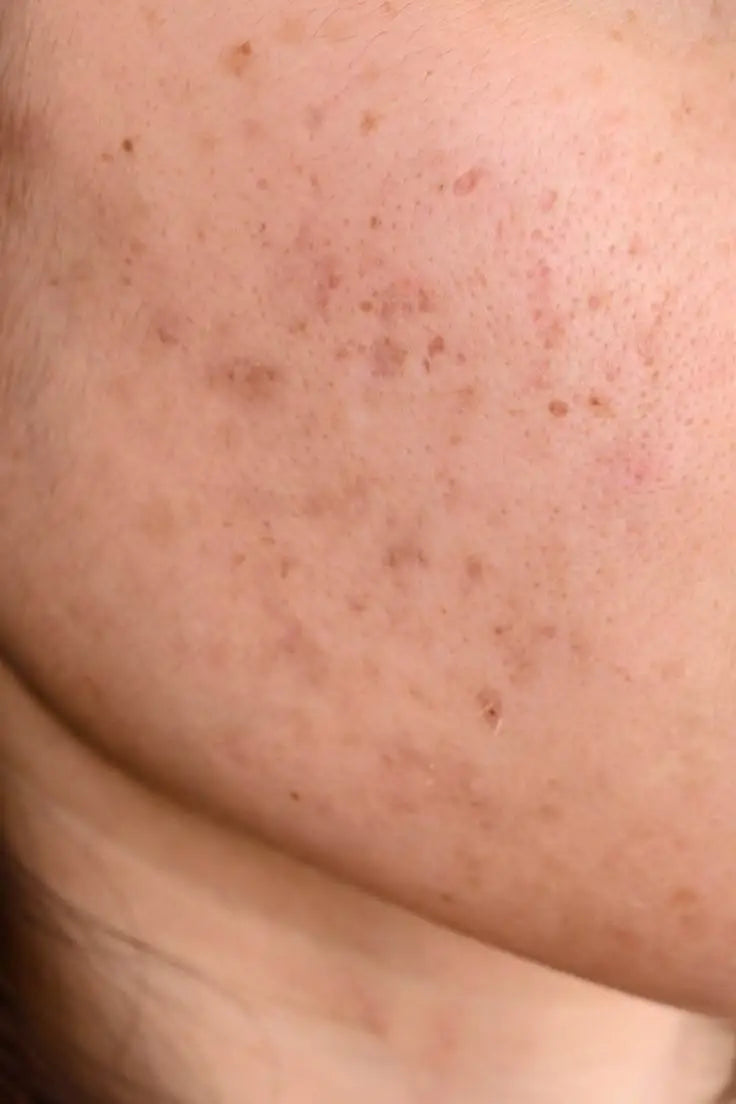 How To Get Rid Of Acne Scars Naturally