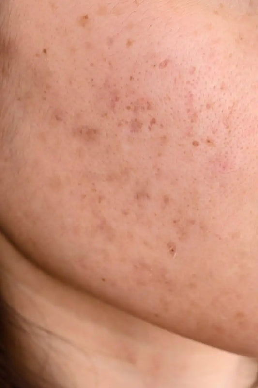 How To Get Rid Of Acne Scars Naturally