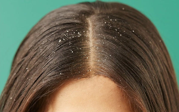 How To Get Rid Of Dandruff ‘Forever’?