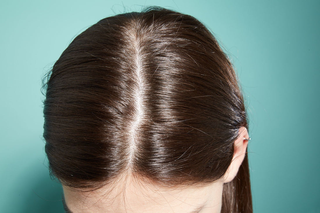 Would applying oil increase my dandruff?