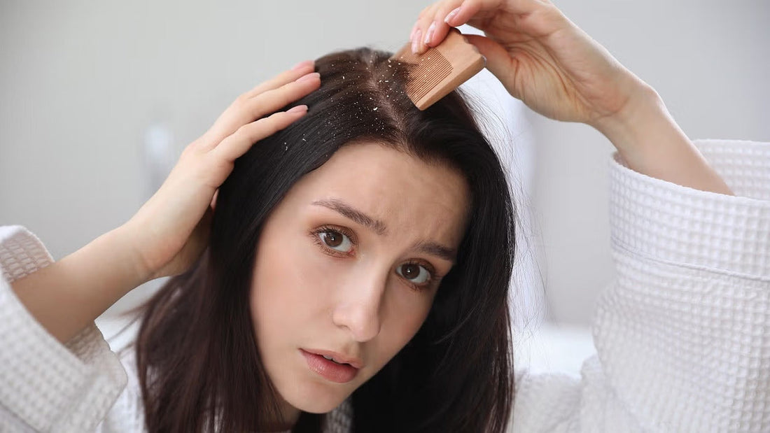 What causes dandruff?