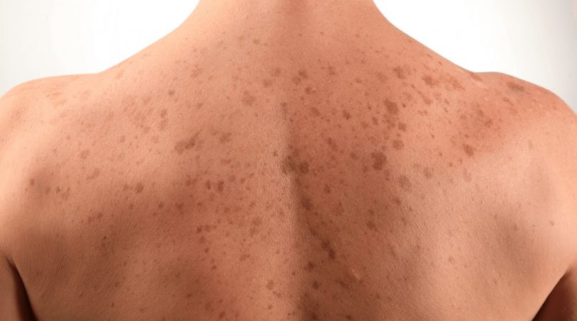 How to remove dark spots on body fast?