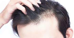 What is Alopecia-areata? How to tackle it