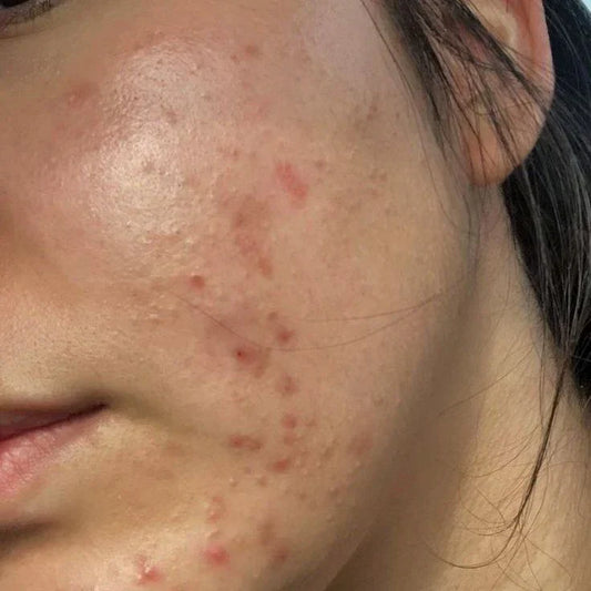 Does Salicylic Acid Remove Acne Scars