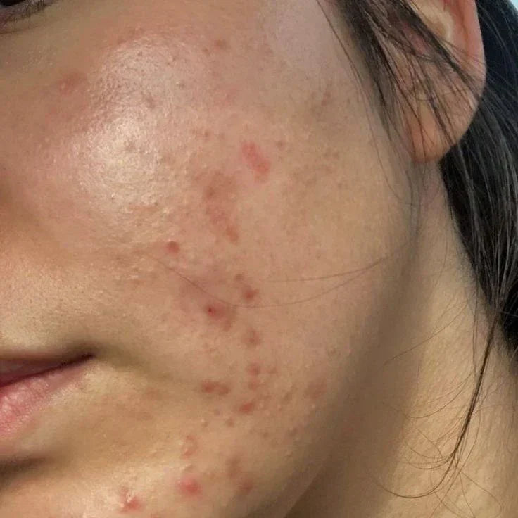 Does Salicylic Acid Remove Acne Scars