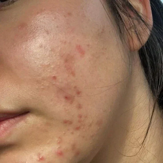 Does Salicylic Acid Remove Acne Scars