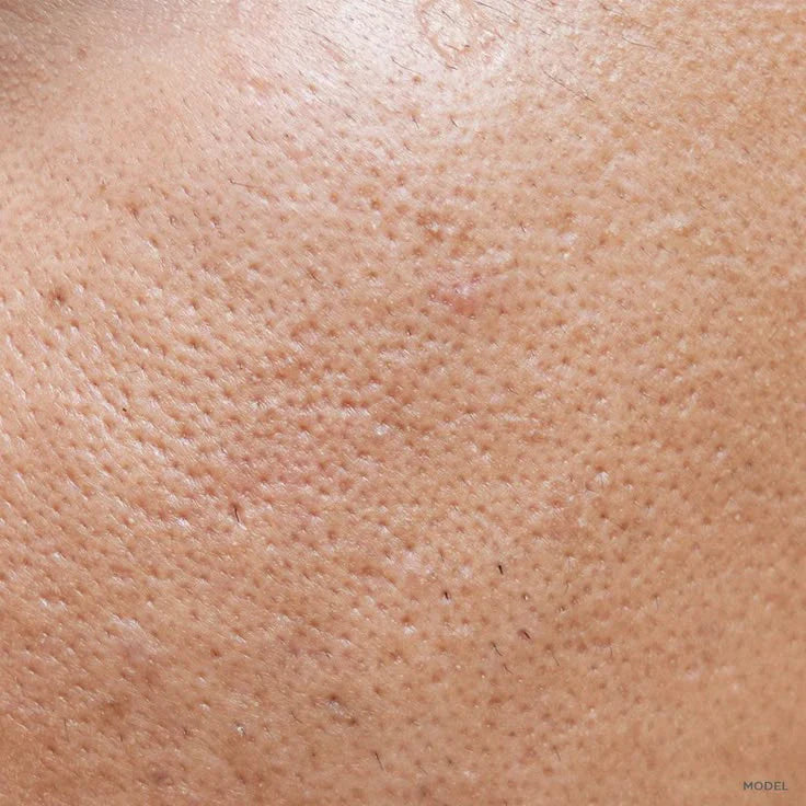 Can Open Pores Be Treated