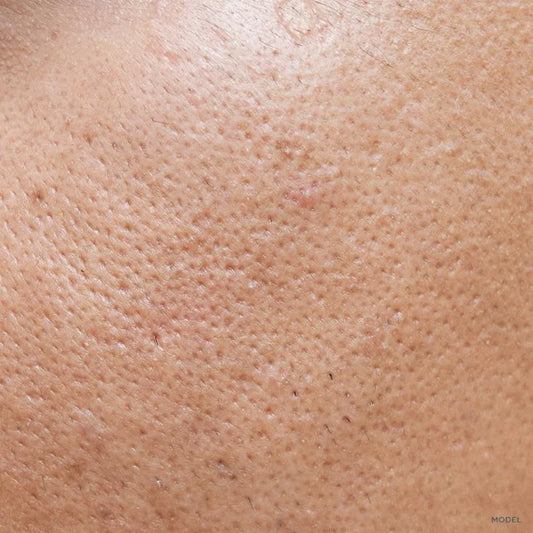Can Open Pores Be Treated