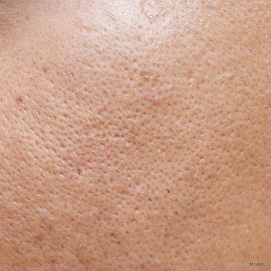 Can Open Pores Be Treated